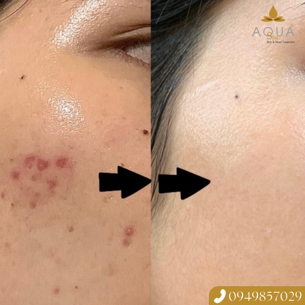 Ưu Đãi Độc Quyền 20 Suất Trị Mụn Giảm Đến 80% Chỉ Với 296k/Lần