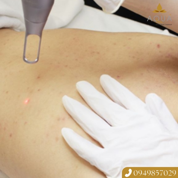 Mẹo Giảm Thâm Mụn Lưng Với Peel Da Kết Hợp Ánh Sáng Lumifacial Tại AQUA SPA