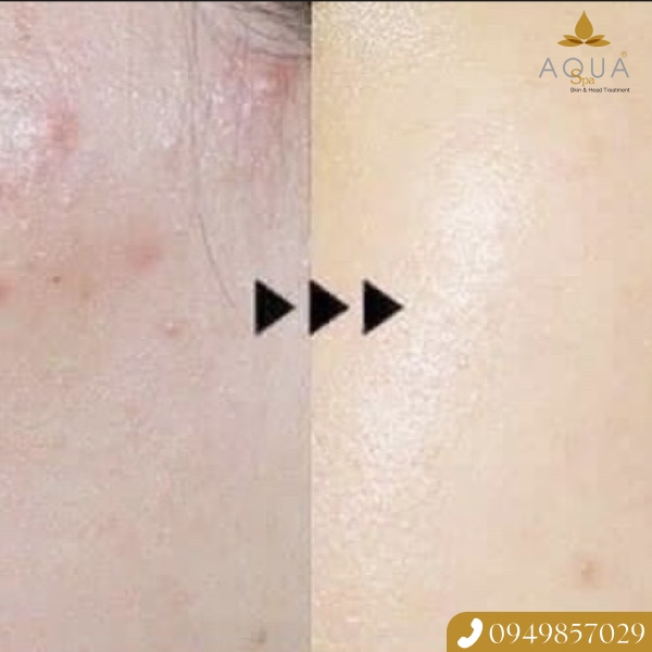 Ưu Đãi Độc Quyền 20 Suất Trị Mụn Giảm Đến 80% Chỉ Với 296k/Lần