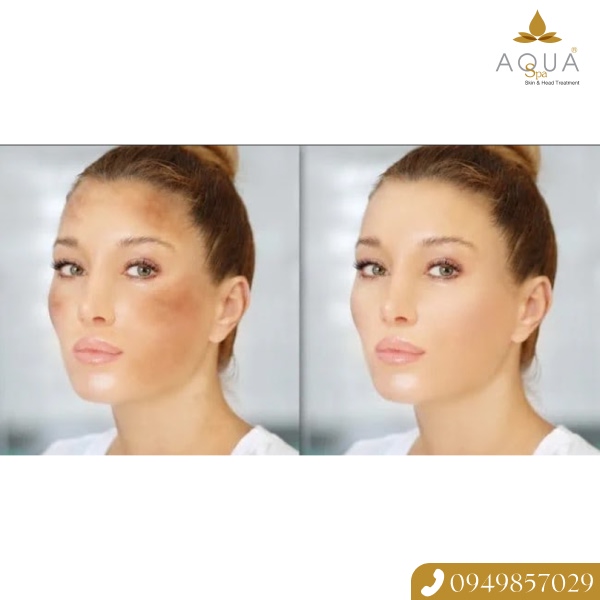 AQUA SPA의 첨단 기미 치료 및 피부 미백 기술 덕분에 고르고 탄력 있게 빛나는 피부 톤