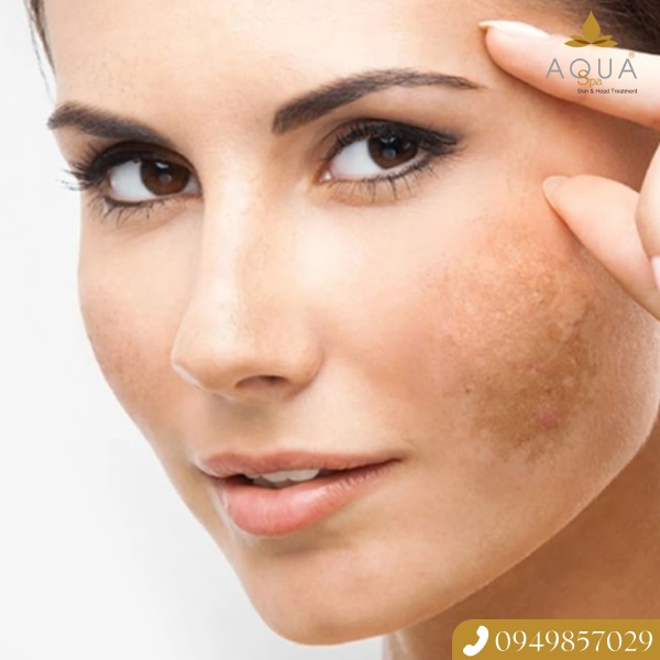 TÂM LÝ HOÀN HẢO VÀ LỜI GIẢI CỦA LASER CO2 FRACTIONAL: DỨT ĐIỂM TÀN NHANG & NÓT RUỒI TẠI AQUA SPA