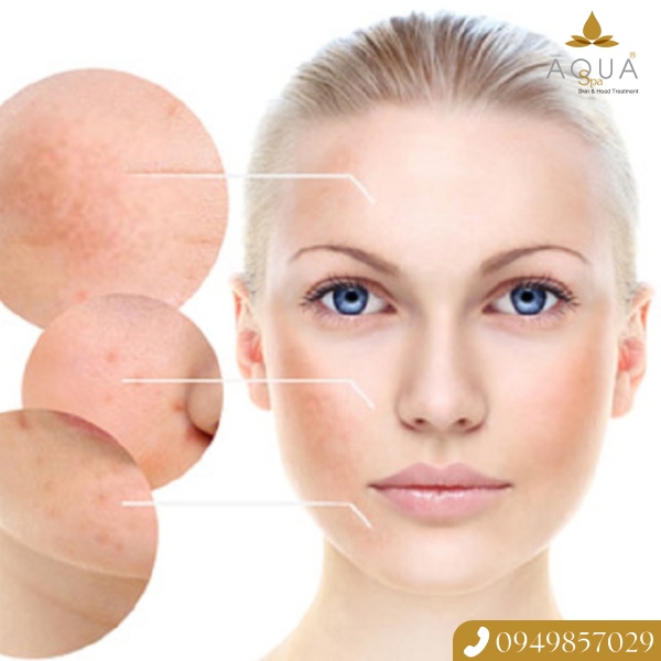 Cấy Bionc: Loại Bỏ Gốc Nám Tận Gốc, Trả Lại Làn Da Trắng Sáng, Mịn Màng